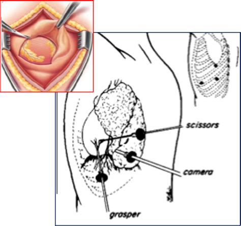 Pericardial Diseases | Dr Krasopoulos