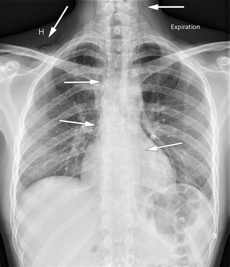 Spontaneous pneumomediastinum | Tidsskrift for Den norske legeforening