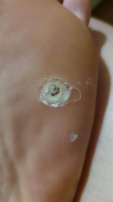 Dear experienced wart removal redditors, at what stage is my verruca at now? I've been using ...