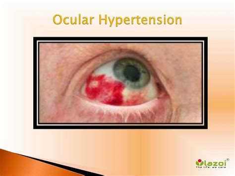 PPT - Ocular Hypertension: Causes, Symptoms, Daignosis, Prevention and ...