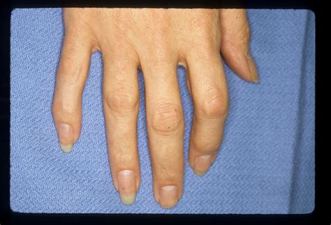 Dupuytren's: Knuckle Pads: Dorsal Dupuytren Nodules