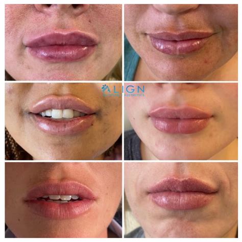 FAQ: Lip Injections | Align Injectable Aesthetics