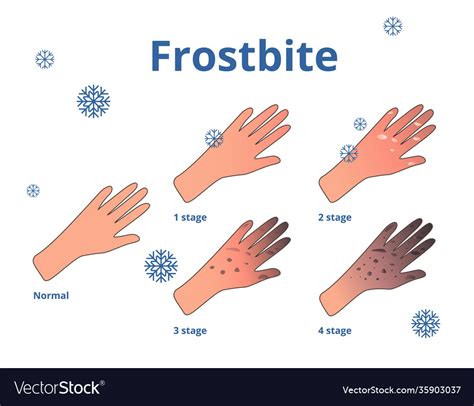 Frostbite stages cartoon Royalty Free Vector Image