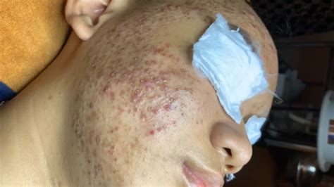 Make your Acne Treatment | Acne spa 610 | Acne spa Treatment - YouTube