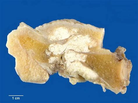 Chronic Tophaceous Gout : Gross Pathology