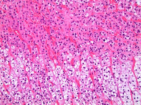 Pathology Outlines Histologyadrenal Cortex