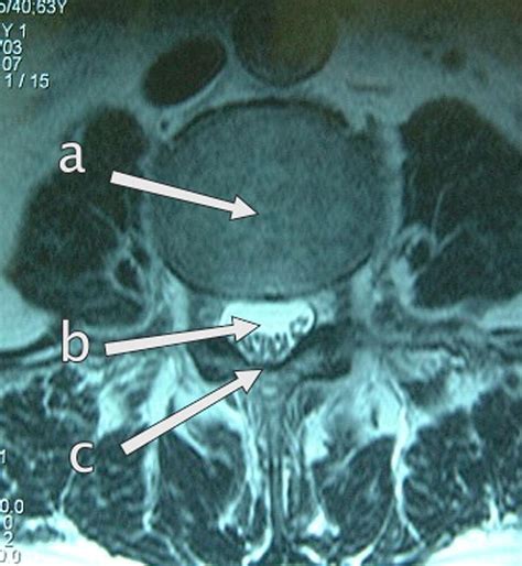 Anatomy of the epidural space - Anaesthesia & Intensive Care Medicine