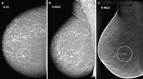 Patient with a 10-mm, grade 1, invasive ductal carcinoma in a...