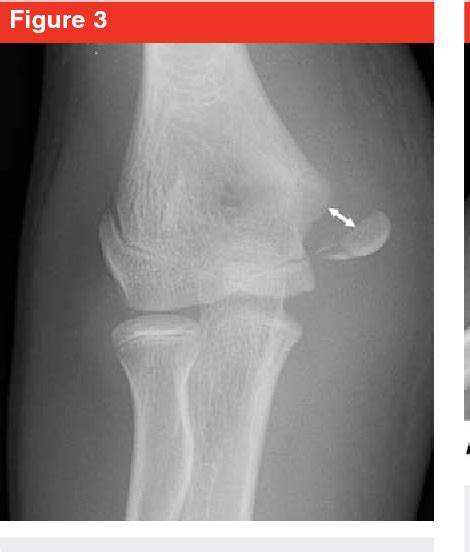 Medial Epicondyle Fracture