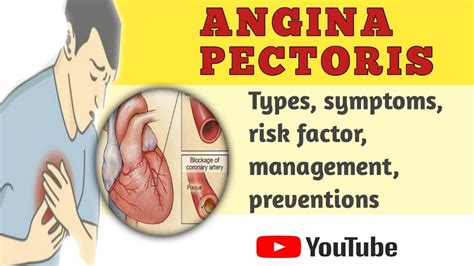 Angina - Cause, Symptom, Treatment & more.... | MEDLINE PROFESSION ...