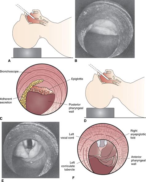 Rigid Bronchoscopy: Indications and Techniques - Operative Techniques ...