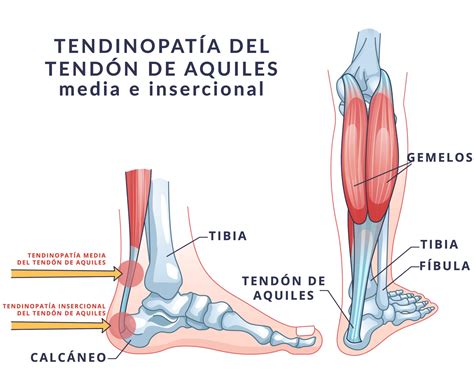 lesiones-del-tendon-de-aquiles | ICONICA Servicios Médicos