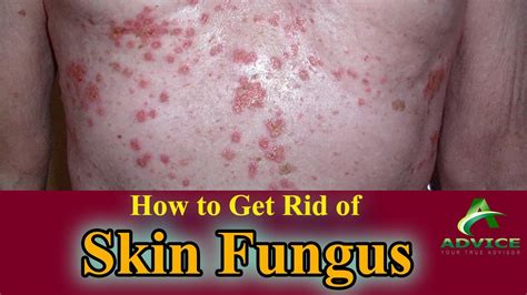 How to Get Rid of Skin Fungus | Get Pure and Clean Skin | Fungus Free ...
