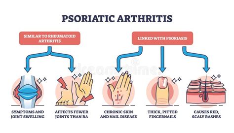 Psoriatic Arthritis As Chronic Dermatological Skin Condition Outline ...