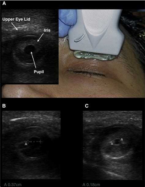 Ultrasound assessment of extraocular movements and pupillary light ...