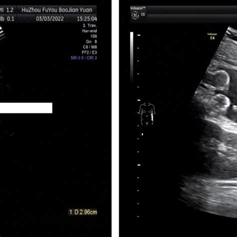 Ultrasonic findings indicating a large amount of peritoneal effusion ...