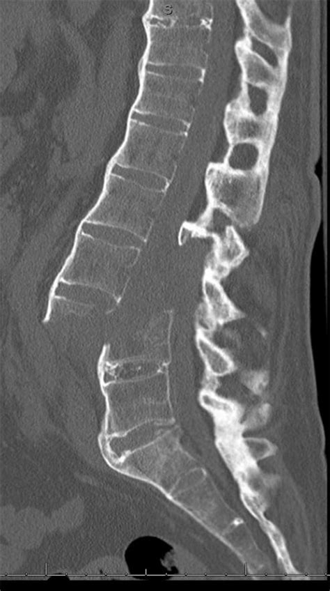 Lumbar Fracture X Ray