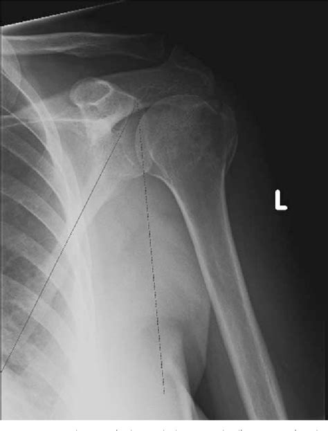 Figure 37-19 from GLENOID FRACTURES SCAPULAR NECK FRACTURE THE SUPERIOR SHOULDER SUSPENSORY ...