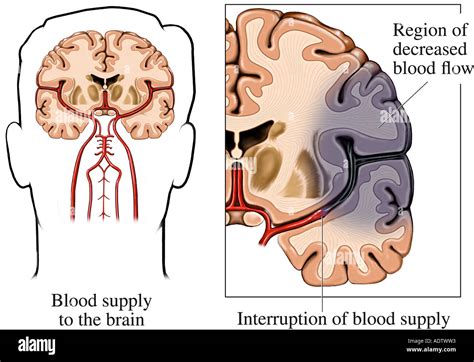 Pathophysiology Of Ischemic Stroke