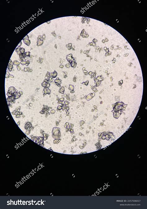 Microscopic View Struvite Crystals Urinary Sediment Stock Photo ...