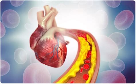 Risks and Side Effects of Heart Stents