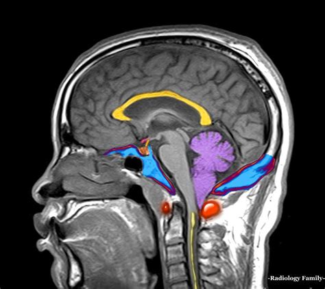 Cerebellar Tonsils Mri