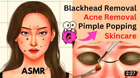 ASMR | Blackhead Removal , Acne Removal Skin Care At Home | Pimple Popping animation - YouTube