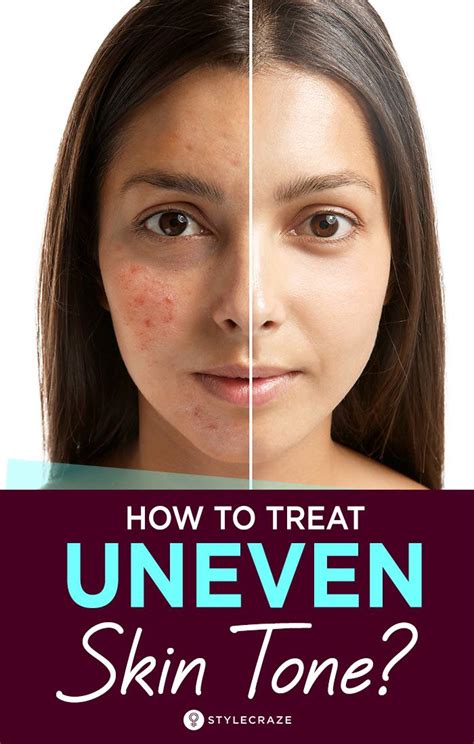 Uneven Skin Tone: Tips To Get Rid Of It Naturally | Uneven skin tone ...