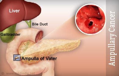 Ampullary Cancer | Cancer of the Ampulla of Vater