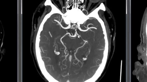 Basilar Artery Anatomy - Anatomy Book