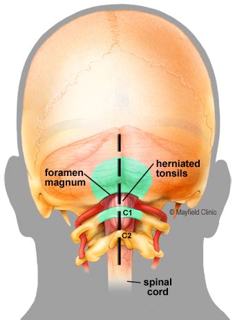 Chiari decompression surgery | Mayfield Brain & Spine | Spinal fluid, Chiari, Cerebrospinal fluid