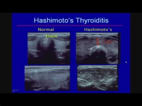 Ultrasound Thyroiditis