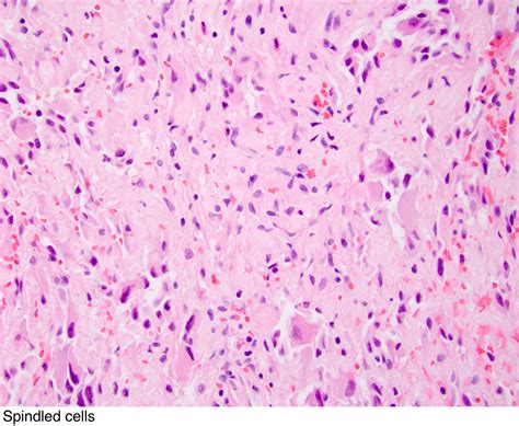 Pathology Outlines - Gangliocytic paraganglioma