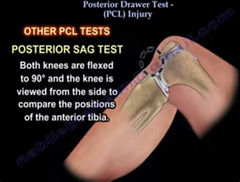 Posterior Drawer Test, #PCL Injury Tests — OrthopaedicPrinciples.com