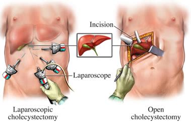 LAPAROSCOPIC GALLBLADDER SURGERY | Surgical Specialists of Southwest Florida