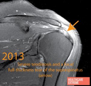 MRI supraspinatus tear