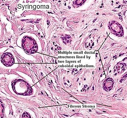 Syringoma Histology