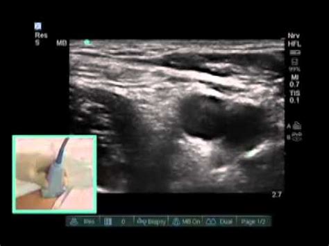 How to: Ultrasound Guided Femoral Nerve Block - YouTube