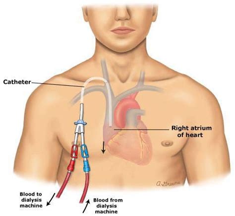 Central Venous Catheter Market Size, Trends, Shares, Insights, Forecast ...