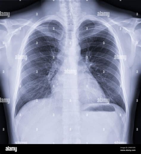 Chest x-ray image , Normal Chest Stock Photo - Alamy