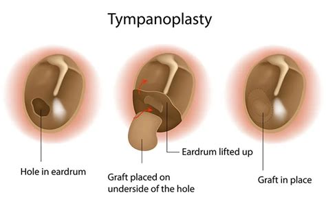 How Do You Know if You Have a Damaged Eardrum - Veney Eleer1949