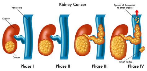 Kidney Cancer Symptoms Usually Occur Later Rather Than Sooner - University Health News