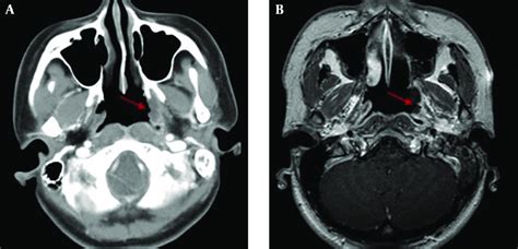 Fossa Of Rosenmuller, Nasopharynx/Nasal cavity at Oregon Health Sciences ... - The human ...