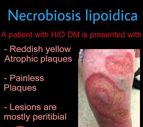 Necrobiosis Lipoidica - MEDizzy