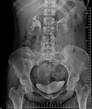 Extrarenal Pelvis