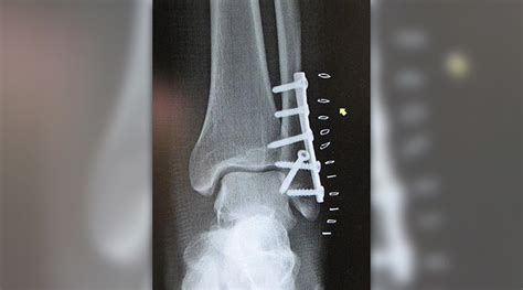 Fibula fracture surgery | General center | SteadyHealth.com