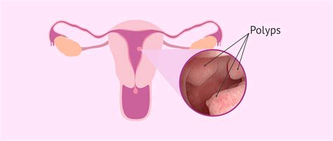 Location of malignant endometrial polyps