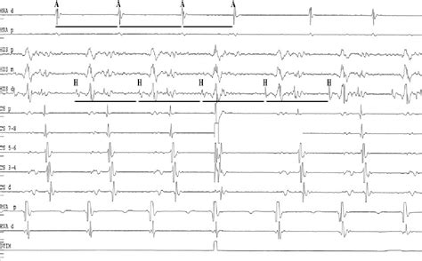 Wenckebach during supraventricular tachycardia. | Semantic Scholar