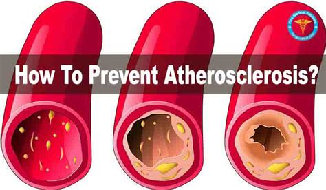 How To Prevent Atherosclerosis? - HealthSips