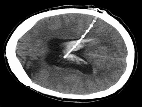 Ventricular Peritoneal Shunt